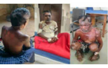 घर में शराब बना रही पत्नी, पति के विरोध पर डाला खौलता पानी; हालत गंभीर, जिंदगी-मौत की जंग जारी